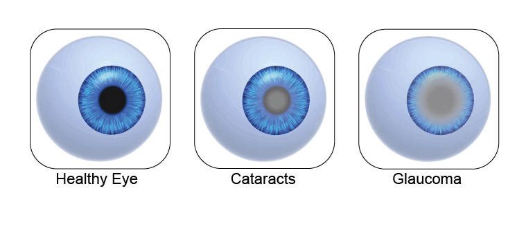 Glaucoma or Ocular Hypertension (OHT)